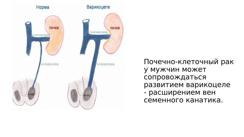 Varicocele classification