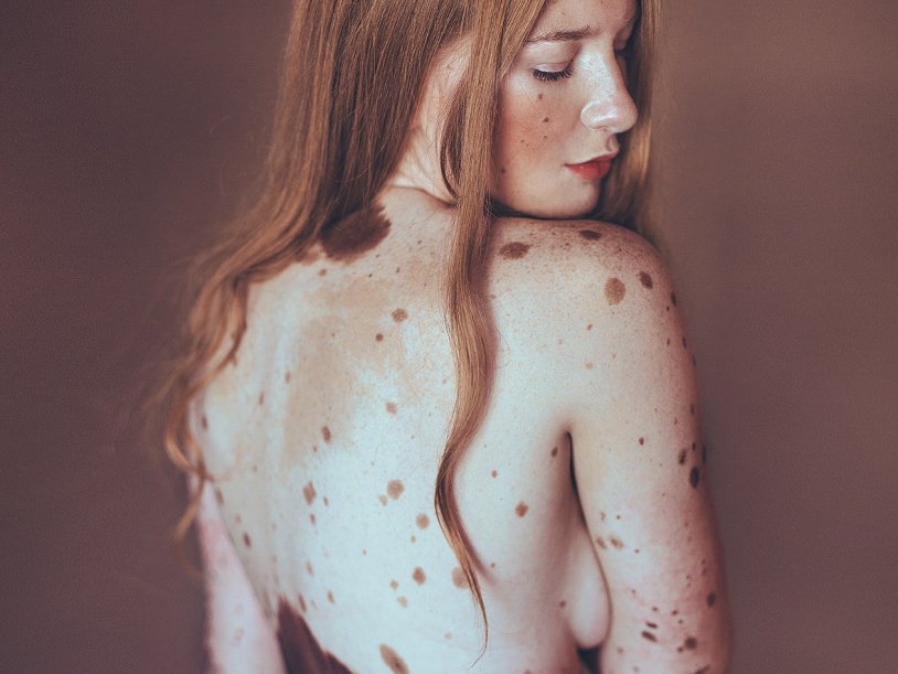 Naked female body with freckles