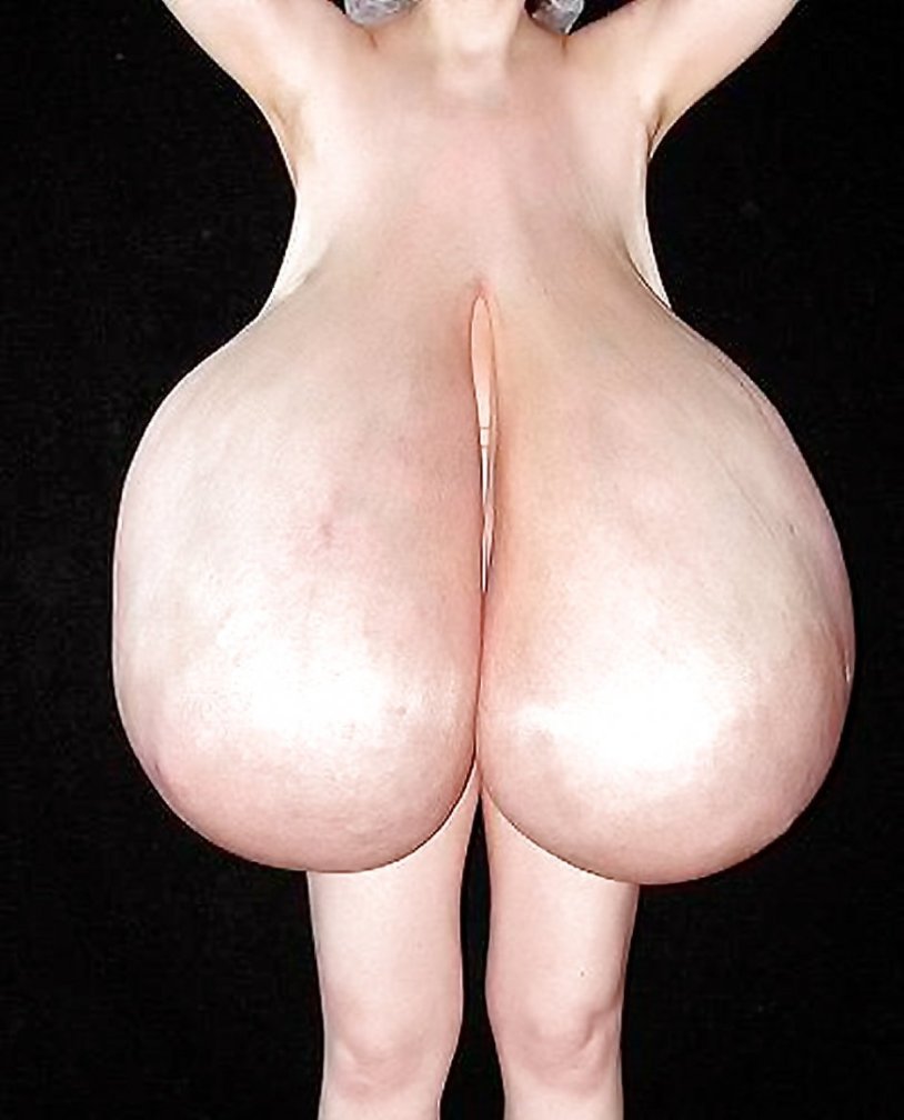 Hypermastia of macromastia