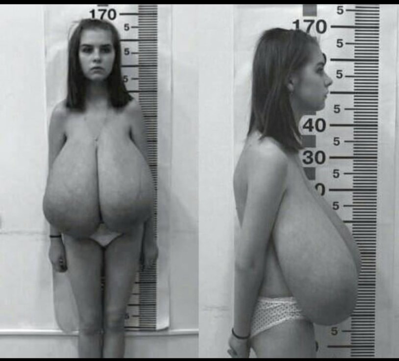 Perthetic macromastia