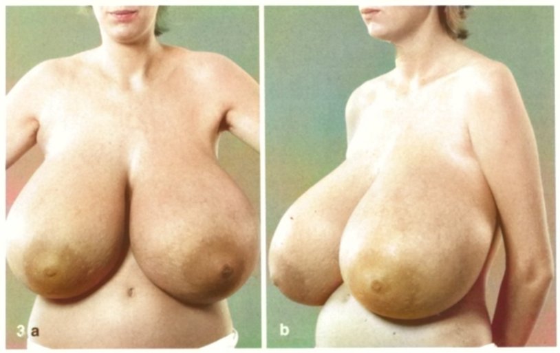 Hypermastia of macromastia