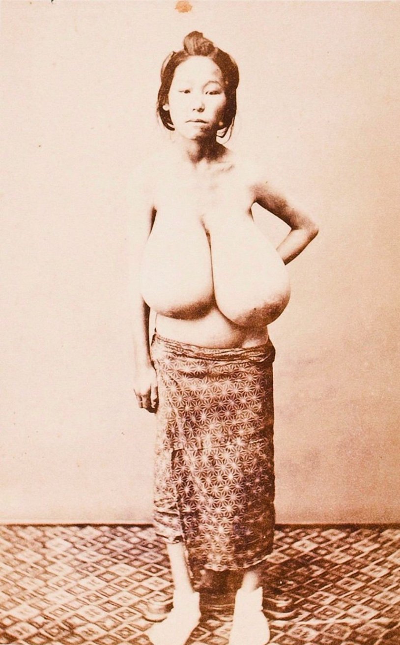 Hypermastia macromastia