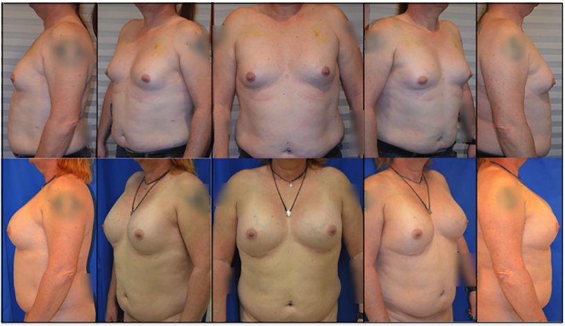 Gynecomastia Stage