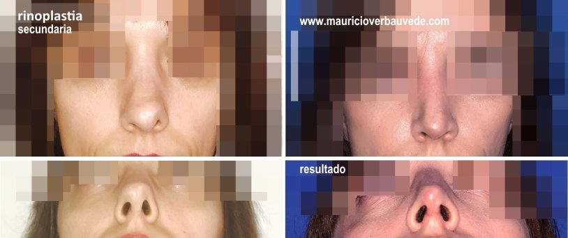 Gasan Ashakhanovich rhinoplasty