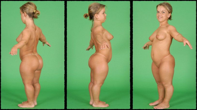 Achondroplasia dwarfs