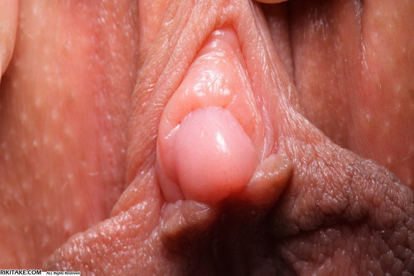 Papilloma in the vagina