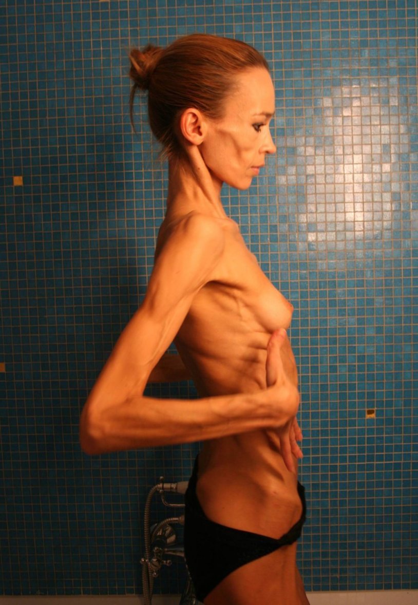 Naked anorexia brunette